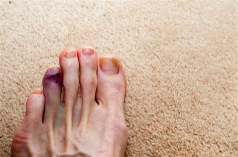 Can You Swim with a Broken Toe? Exploring the Depths of Pain and Possibility